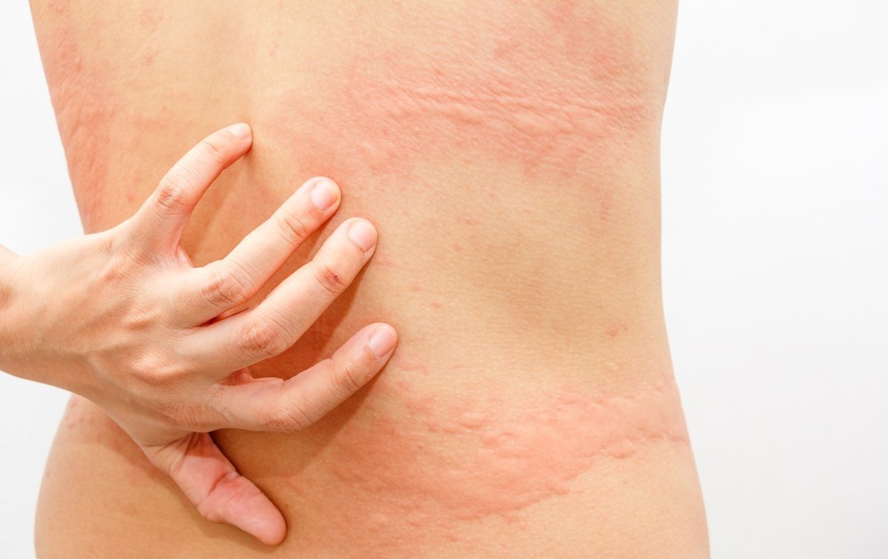 Bí Quyết Làm Khô Quần Áo Nhanh Chóng Ngày Mưa 3 Gây phát ban, mẩn ngứa da
